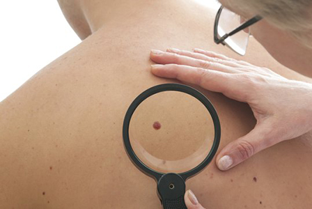 Доказаха връзка между количеството бенки и риска от рак на кожата