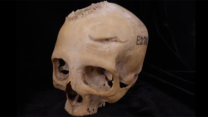 Учени: Египтяните са оперирали тумори преди 4600 години